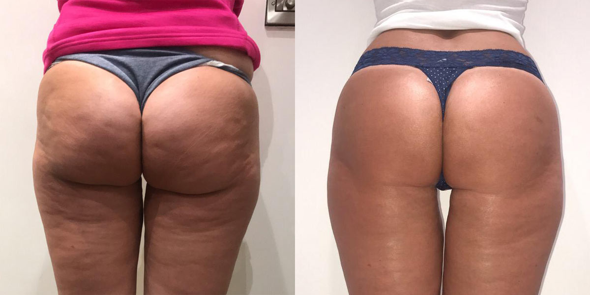 Before-After-02